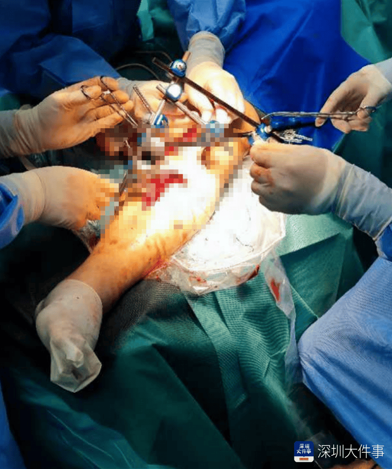 失血过半!深圳男子被三四百斤模具砸到<strong></p>
<p>币安老板</strong>,医生全力抢救