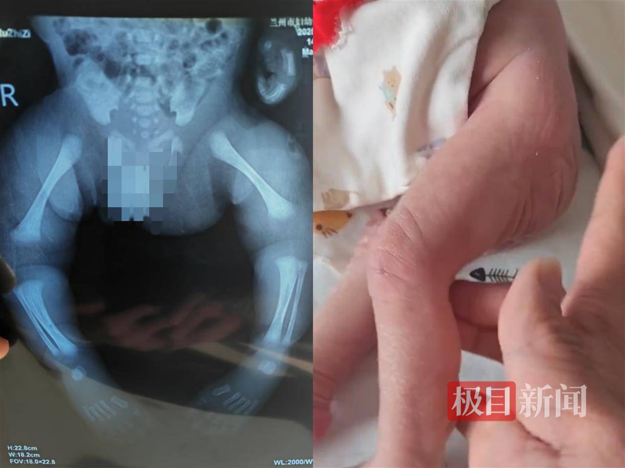 二胎出生查出先天性病症或落下残疾<strong></p>
<p>币安最新动态</strong>，残疾父母称医院产检漏检、未尽告知义务，医院及医调委回应