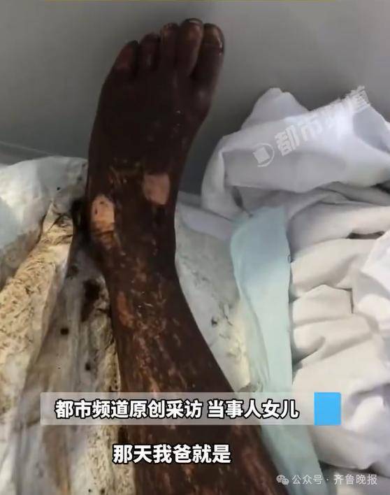 安徽宣城一男子走路玩手机<strong></p>
<p>抹茶交易所钱包注册</strong>,一脚踩中打架的竹叶青和五步蛇,被俩毒蛇咬3口!医院:暂无生命危险,正在治疗