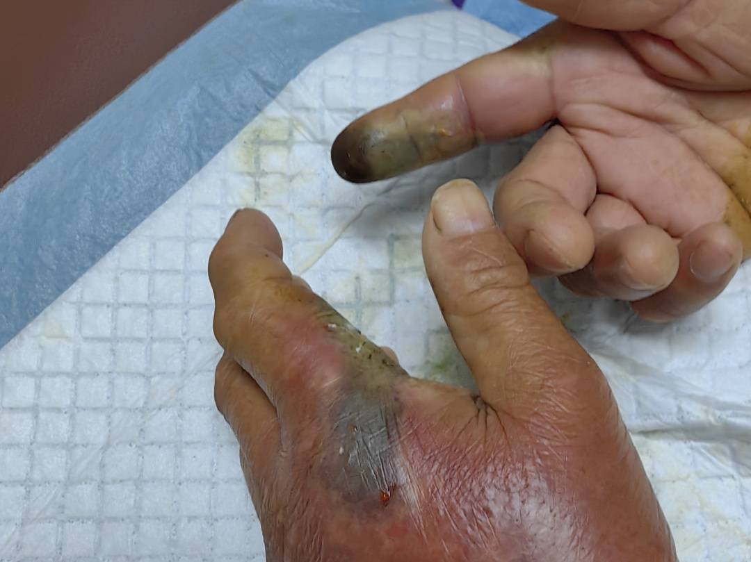 眼镜王蛇咬伤老人<strong></p>
<p>抹茶交易所美区</strong>,家属拖两米多长的“凶手”冲进医院!“拎蛇就医”可取吗?