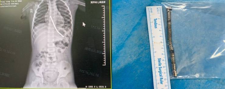 整整40颗<strong></p>
<p>抹茶交易所杠杆多少</strong>！湖南3岁男童身体里取出……医生紧急提醒