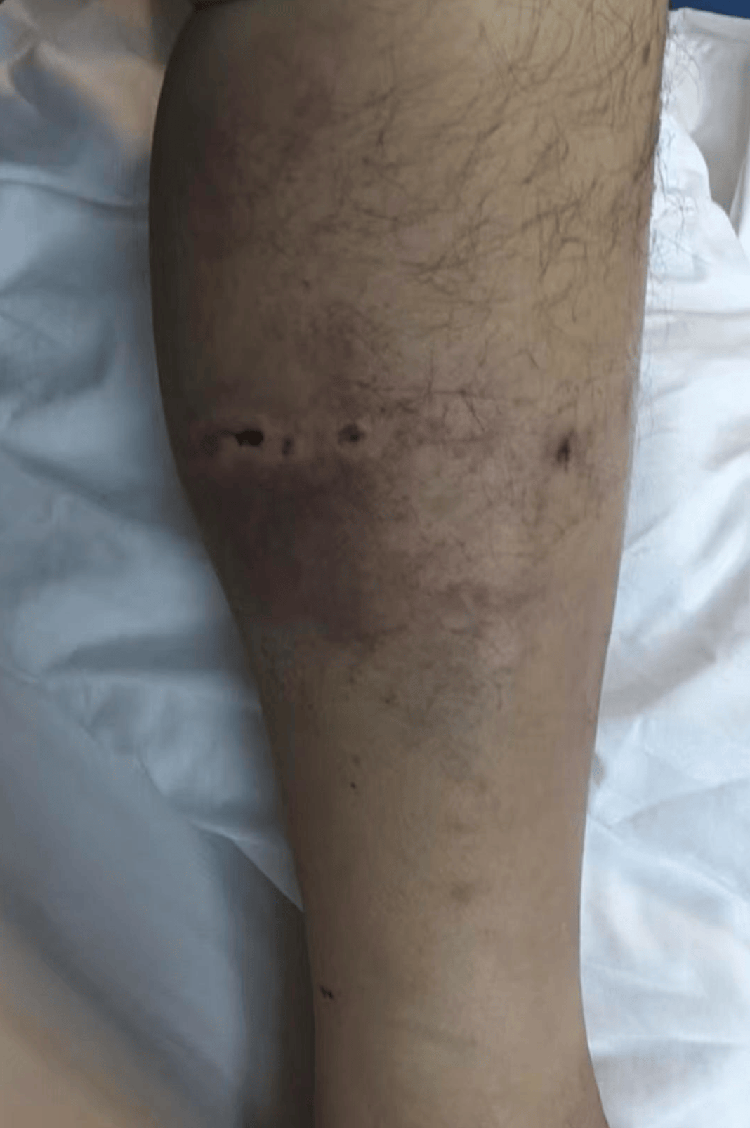 重庆男子上山采菌正面遇黑熊袭击<strong></p>
<p>抹茶交易所最低交易金额</strong>，当事人：小腿被咬，穿的水鞋救了我一命；遭一掌打下山坡后险坠山崖幸被树枝拦住，醒后找到手机求救