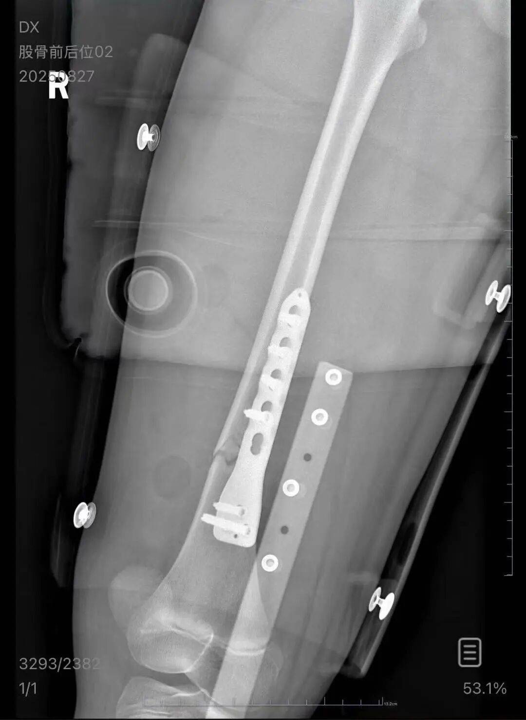 男子火车上铺跌落砸断10岁女孩腿骨<strong></p>
<p>越南抹茶交易所</strong>，回应“失联”称失业讨薪中