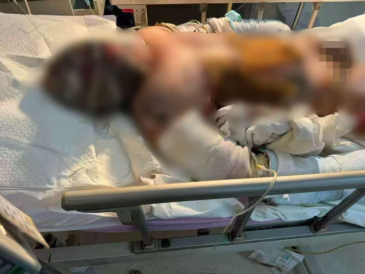 父子在哈尔滨一亲戚公司上班遇爆炸全身烧伤<strong></p>
<p>抹茶交易所杠杆代币</strong>，治疗花费近百万公司拒赔偿？亲戚回应