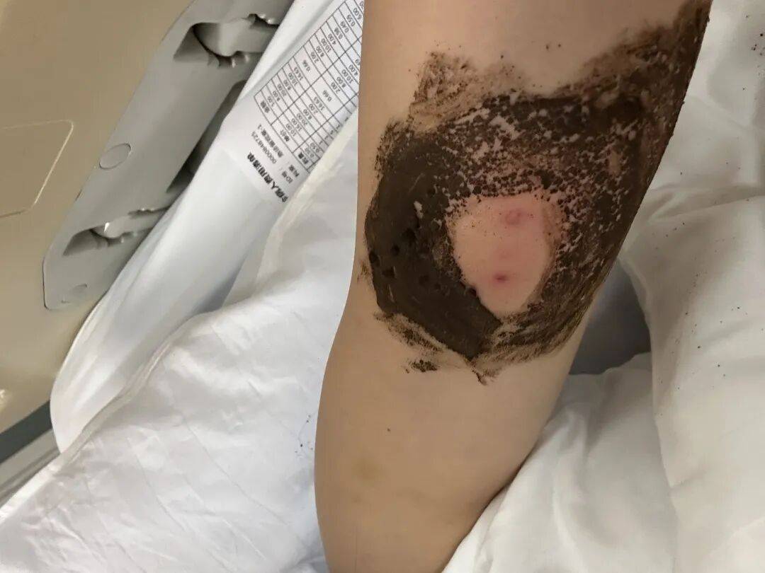 4名游客景区内遭马蜂袭击<strong></p>
<p>抹茶交易所杠杆代币</strong>,旅游度假区:是森林公园不卖门票,蜇伤先就医后提供证据投诉