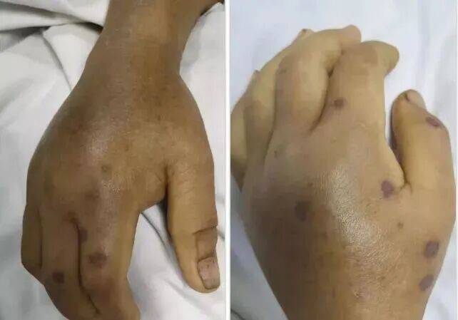 深圳一市民突遭马蜂围袭！已进入高发期<strong></p>
<p>抹茶交易所杠杆代币</strong>，千万别招惹！