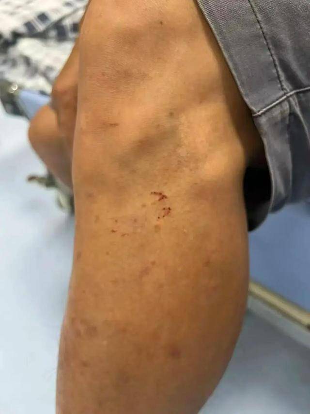 广东62岁阿叔网鱼网到2条眼镜蛇<strong></p>
<p>海外版下载链接</strong>，被咬伤后当场打死，并打包提进医院